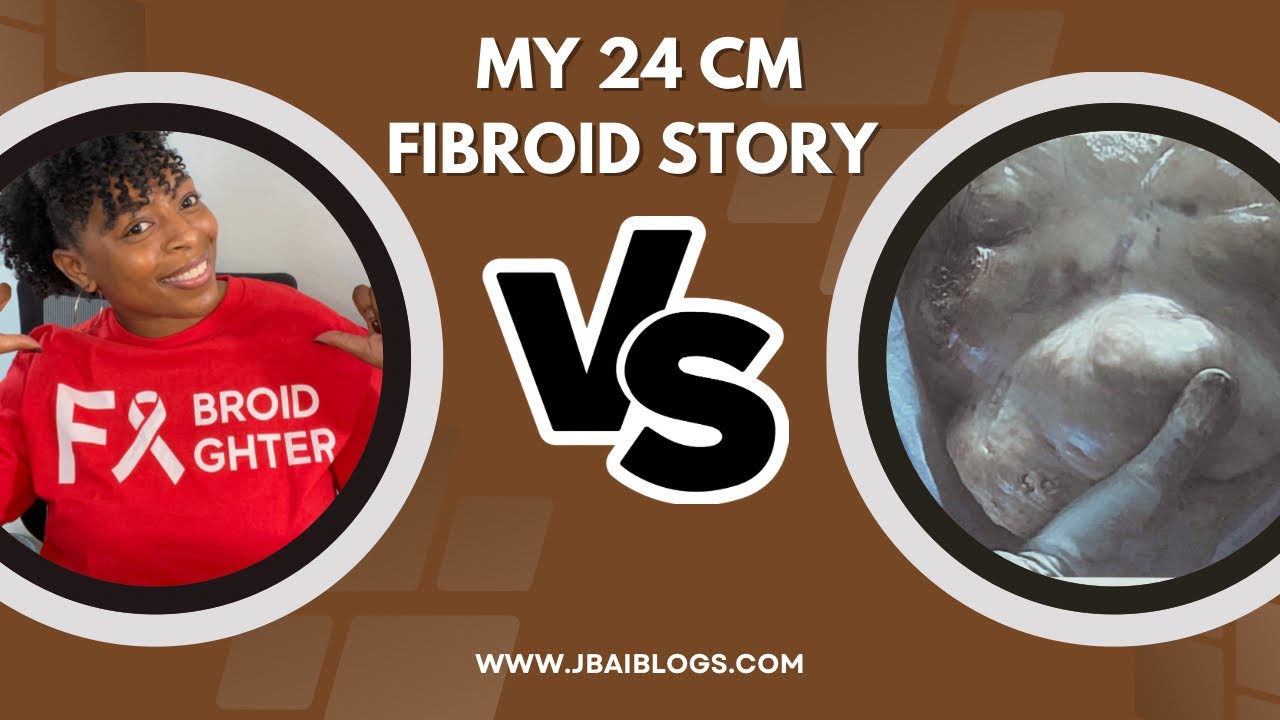 MASSIVE FIBROID TUMOR JOURNEY | Symptoms & Diagnosis #fibroid  #HealingJourney #Health #womenshealth