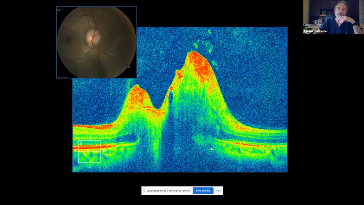OCT in Neuro ophthalmic Disorders