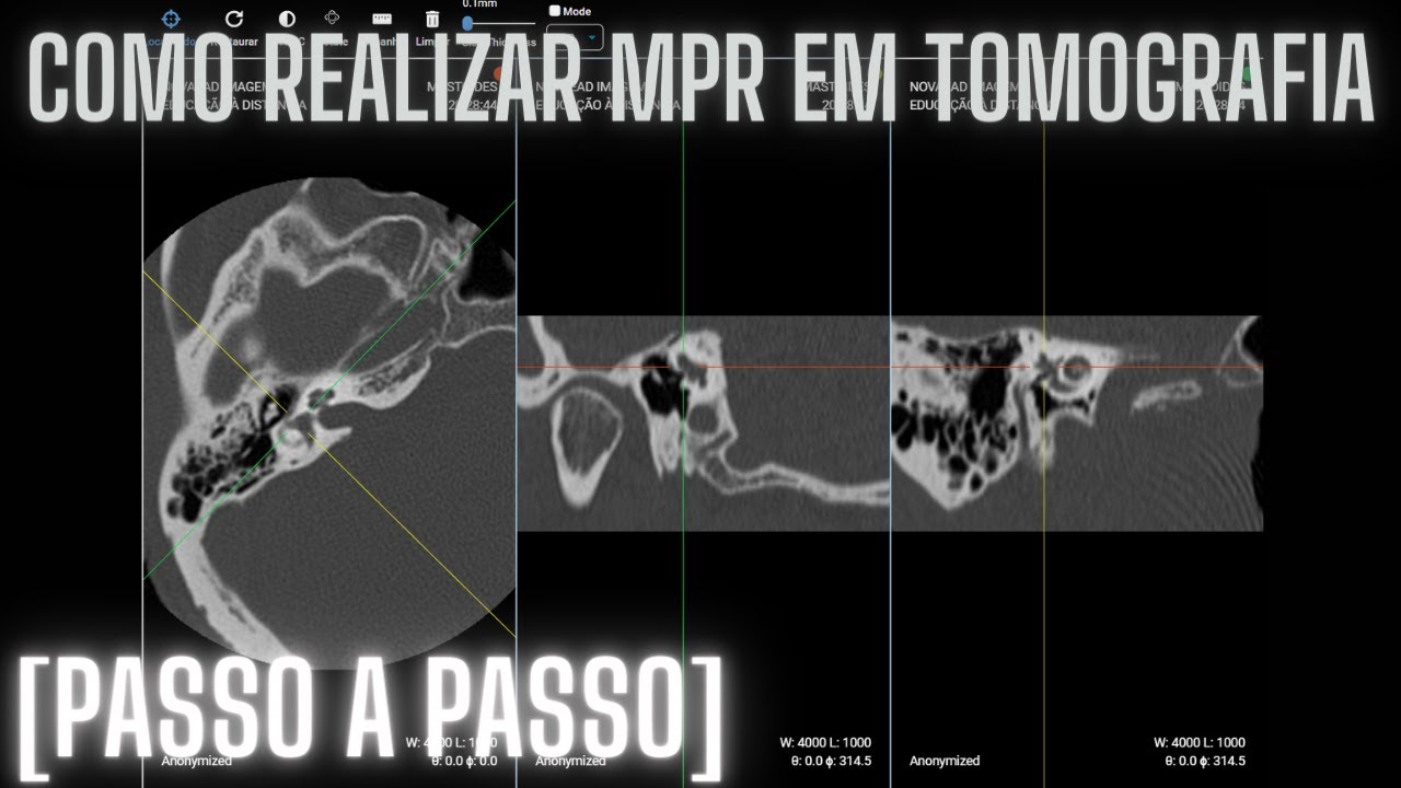 [COMO FAZER] REFORMATA&Ccedil;&Atilde;O MULTIPLANAR TOMOGRAFIA