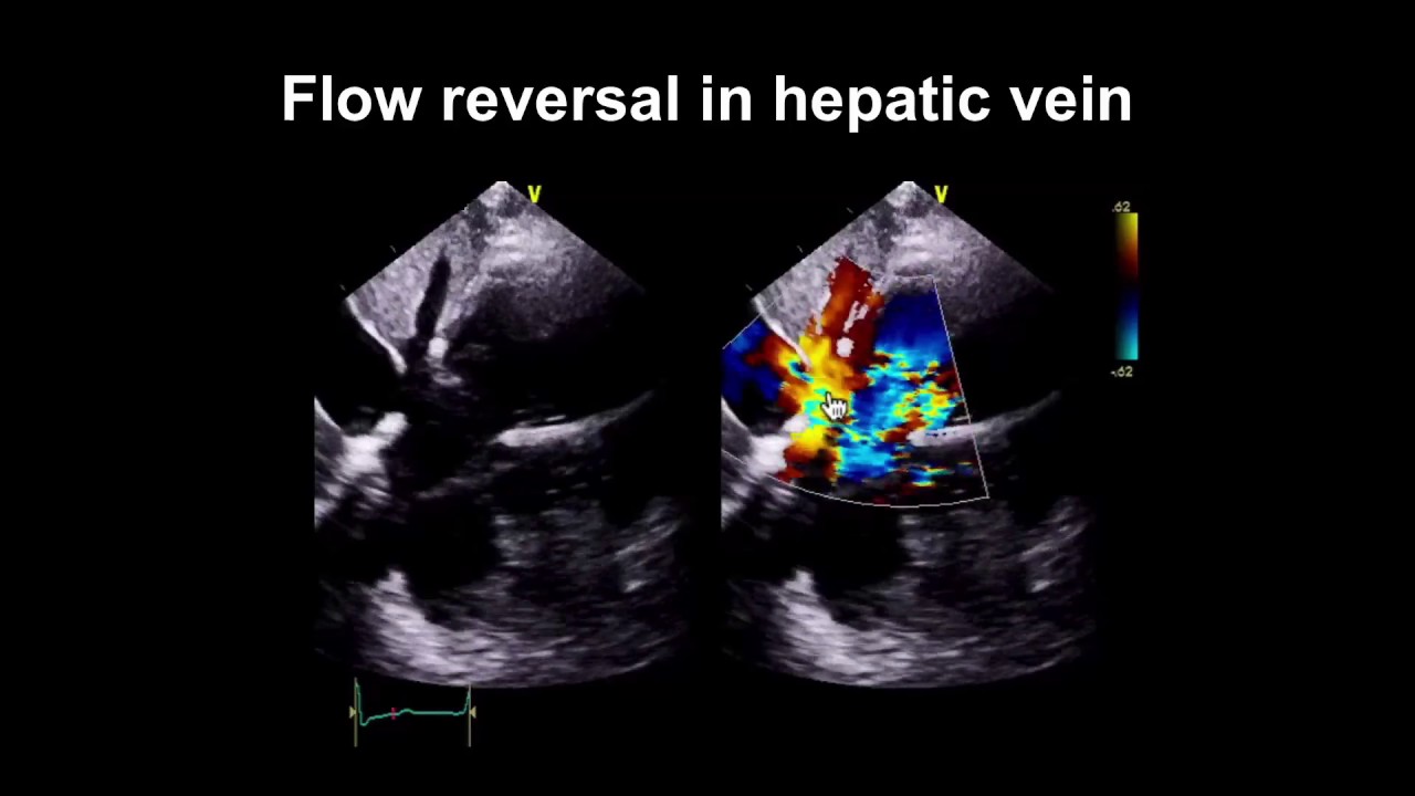 Echocardiography Essentials: Spotting tricuspid and pulmonary valve disease