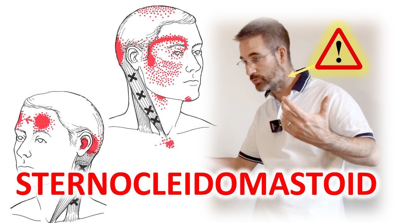 The SCM Muscle of the Neck | A Usual Cause of Neck Pain, Headaches, Dizziness | Sternocleidomastoid