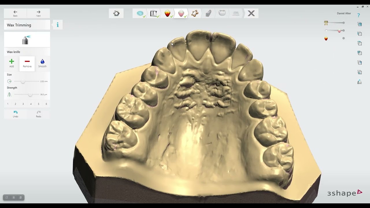 How to Design a Nightguard in 3Shape using Zirlux 3D Print Resins