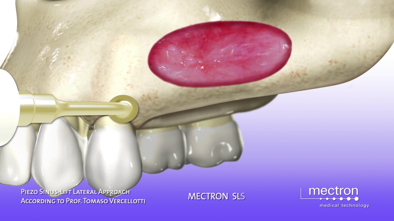 PIEZOSURGERY - ANIMATION - Sinus lift with lateral approach - Sinus Lift Technique (Vercellotti)