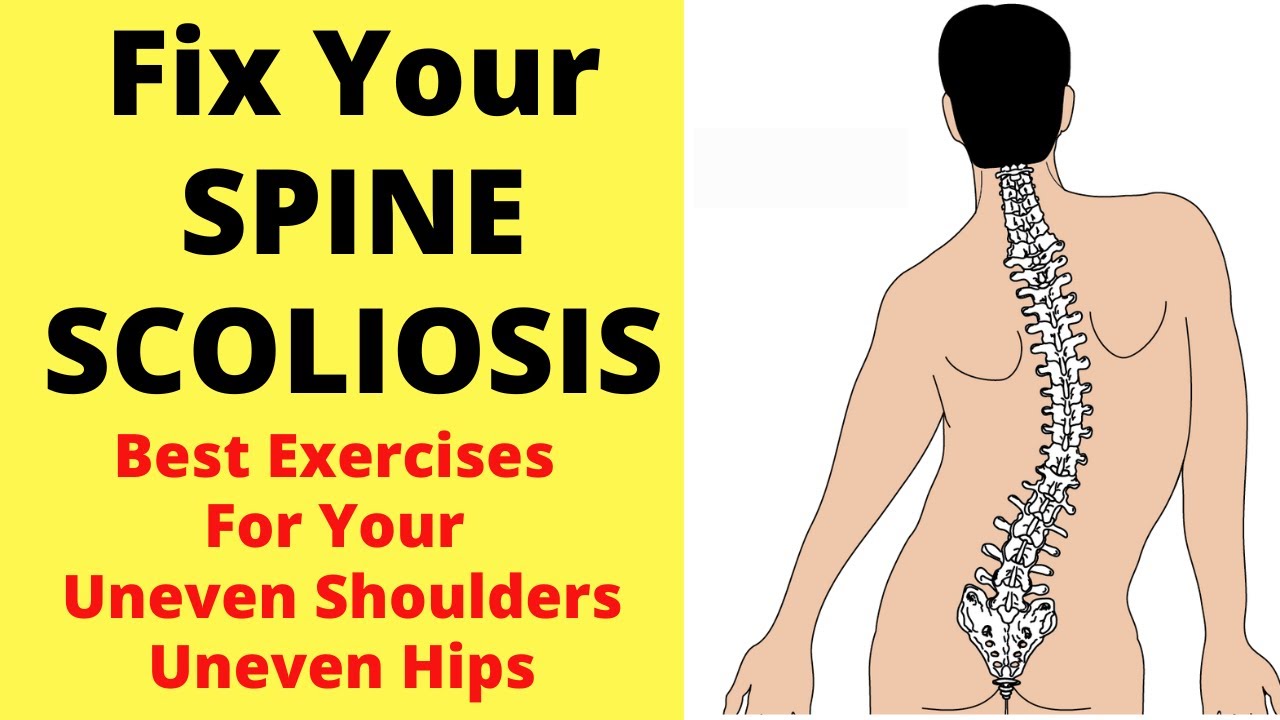 Fix Your Spine Scoliosis | Best Exercises For Scoliosis | Exercises For Uneven Shoulders And Hips