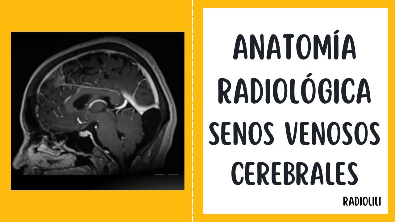 Anatomía Radiológica: Senos venosos cerebrales.