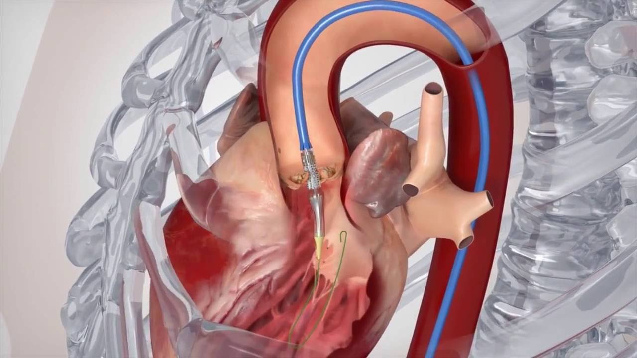 Factors Affecting Recovery From Heart Valve Surgery