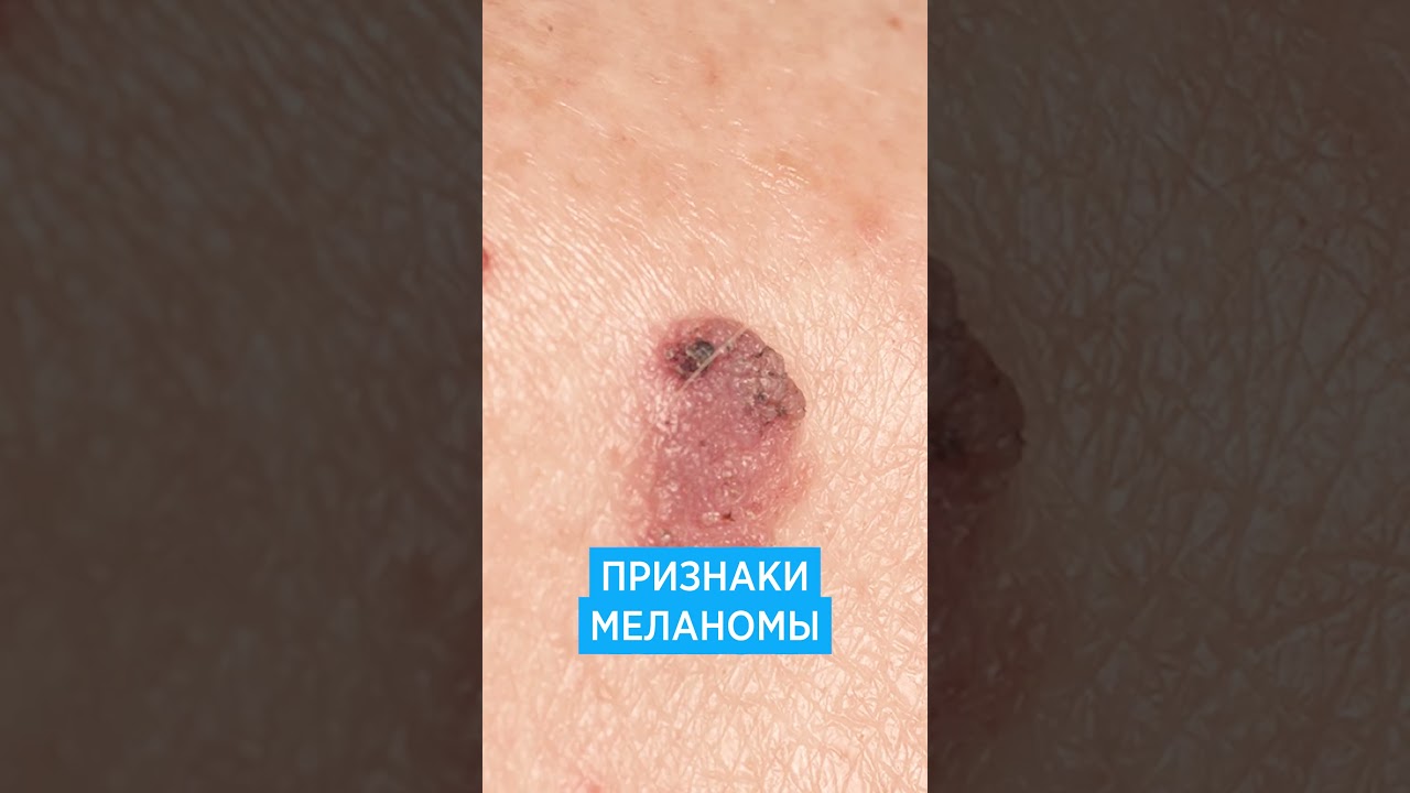 Меланома кожи 📌 симптомы, признаки, фото как выглядит рак кожи