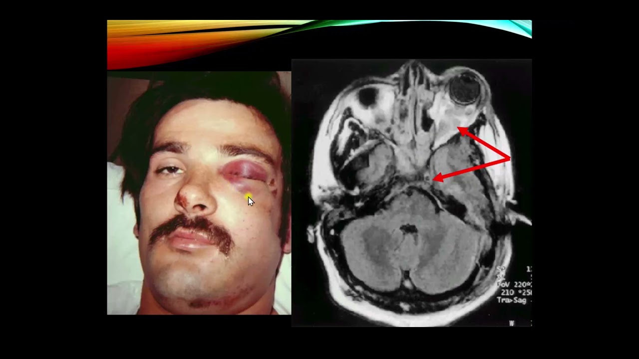 CNS Vasculature, Part 2