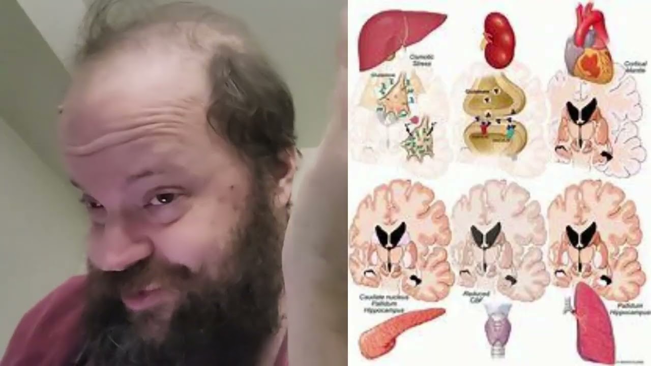 The Essentials of Acquired Brain Injury: Metabolic Encephalopathy (7/9) ...