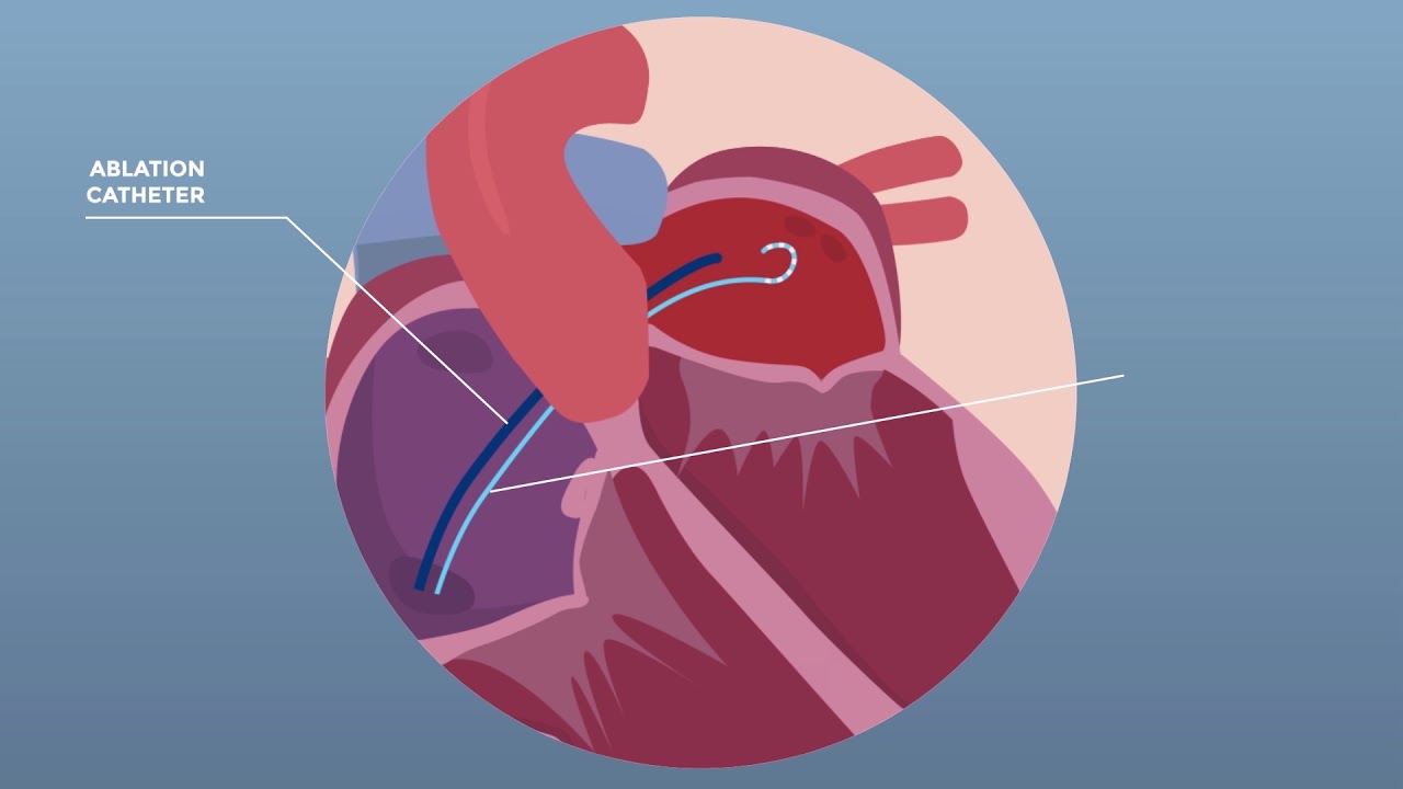 Care4Today Video3  Atrial Fibrillation Catheter Ablation Final 210318 1