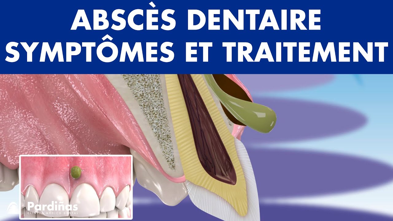 ABSC&Egrave;S dentaire - Sympt&ocirc;mes et traitement de PHLEGMON &copy;