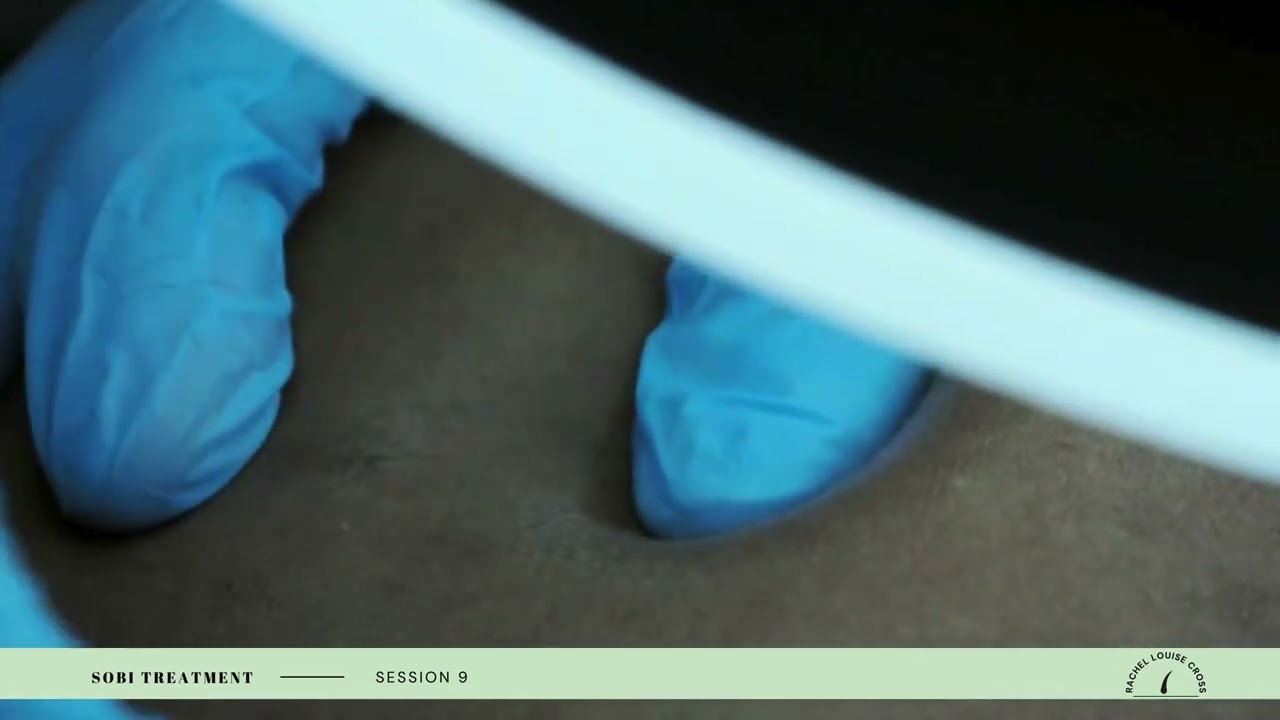 Dr Sobi Electrolysis Journey - Session 9