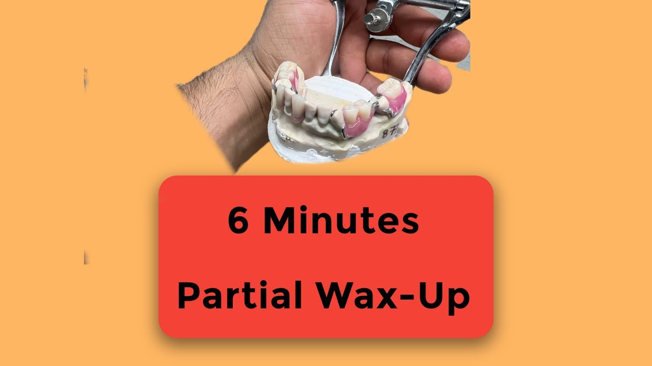 From Zero to Partial Wax-Up in 6 Minutes