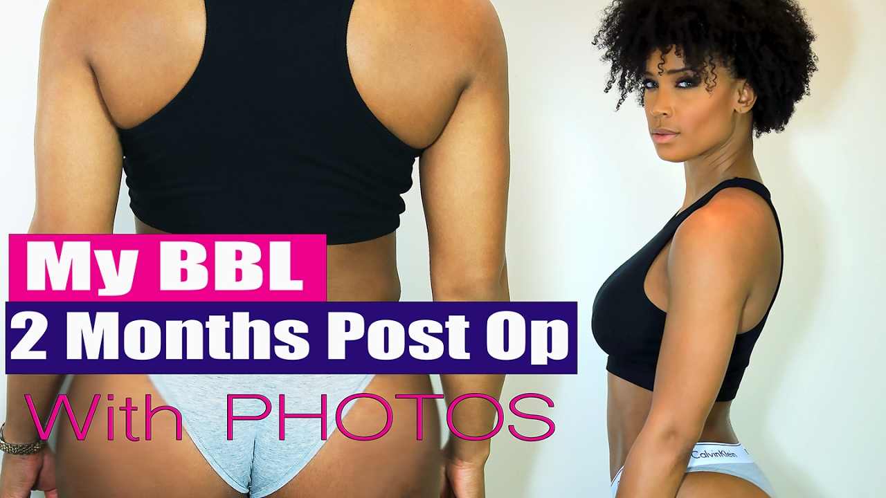 BBL Journey | 2 Months Post Op