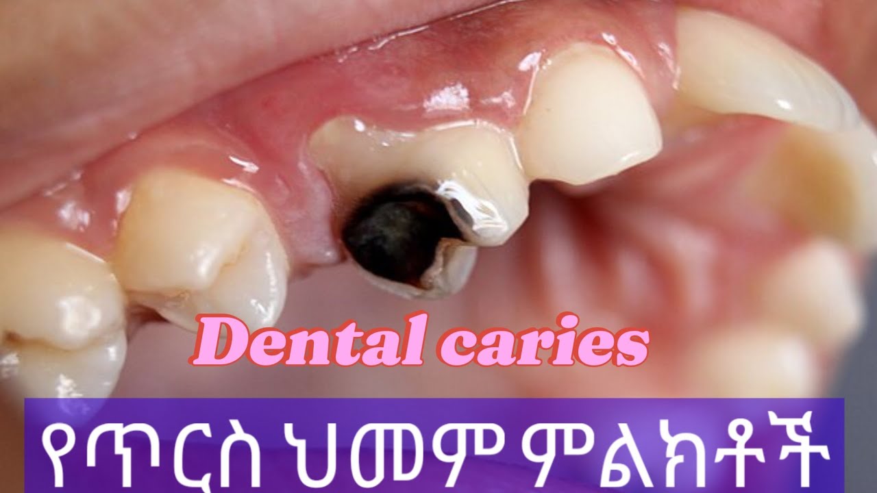 እነዚህ ማታውቋቸው የጥርስ ህመም ምልክቶች ናቸው