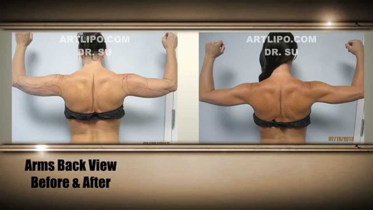 Celebrity Arms - High Definition Arm Liposuction - 4 | Expert Dr. Su