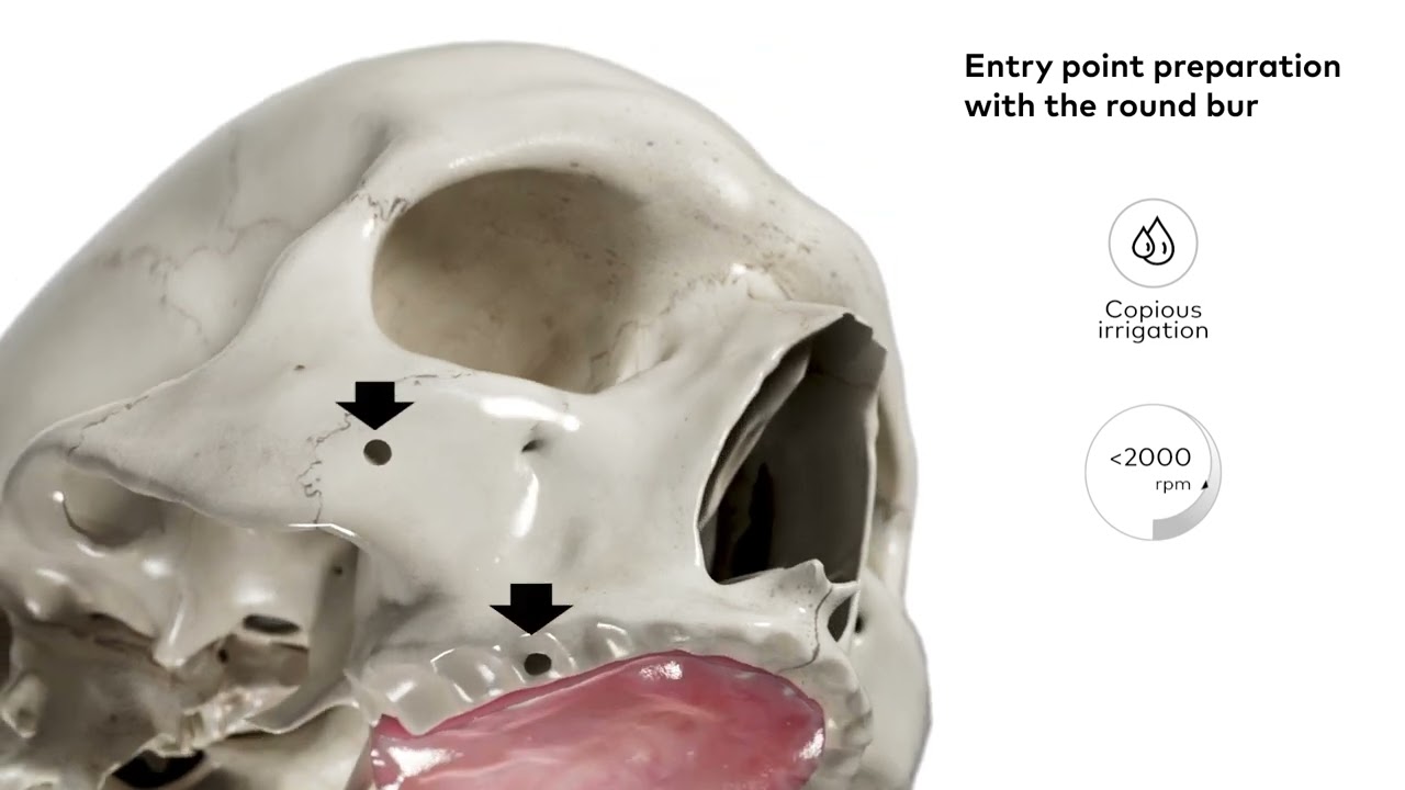 NobelZygoma™ TiUltra™ – Surgical Animation