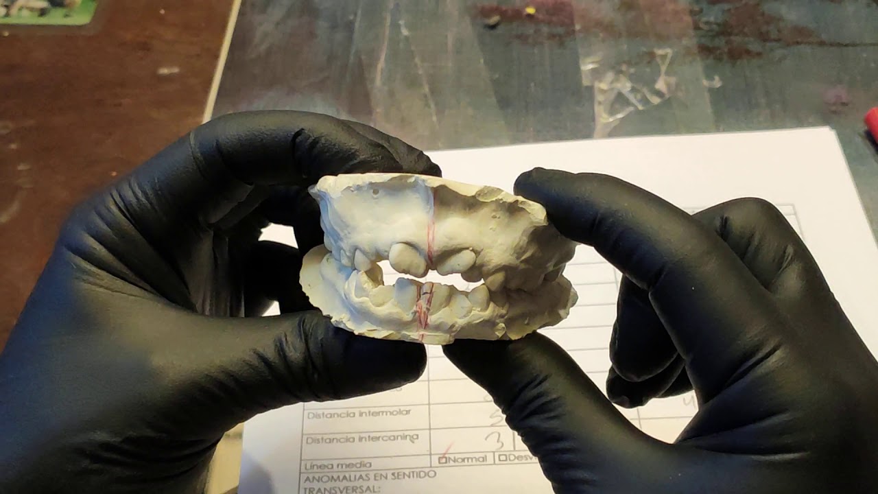 ANÁLISIS DE MODELOS EN ORTODONCIA (MOYERS)