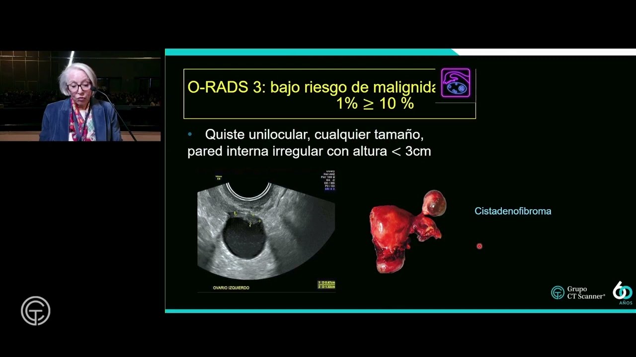 Ultrasonido de ovario O-RADS. Dra. Véronique Barois Boullard