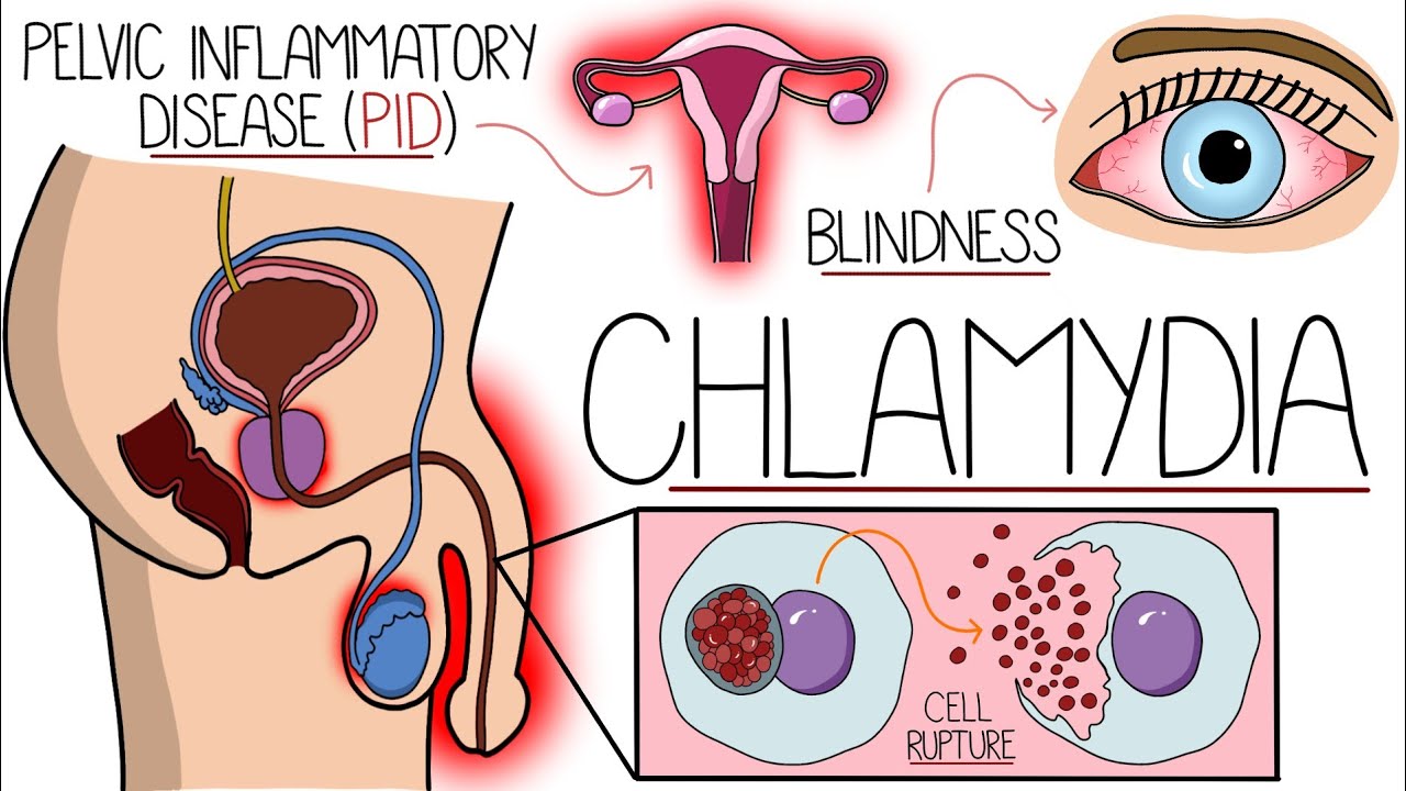 Понимание хламидиоза (Chlamydia Trachomatis: понятное объяснение)