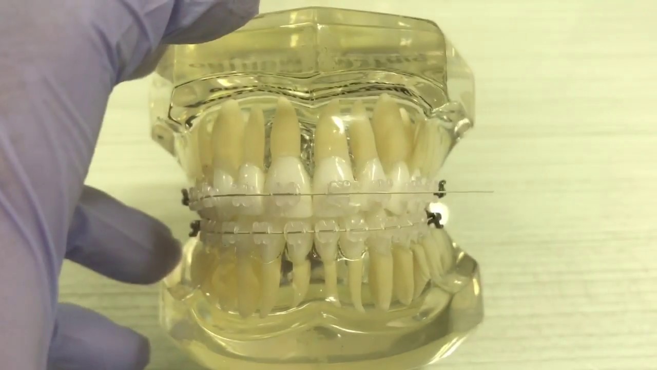 Como usar rotation, rotator ou rotation wedge, Orthodontic Rotational Wedge