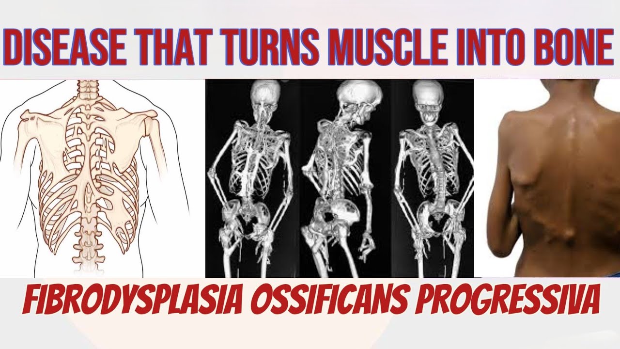 Disease that turns muscle into bone || FIBRODYSPLASIA OSSIFICANS || explained in detail 