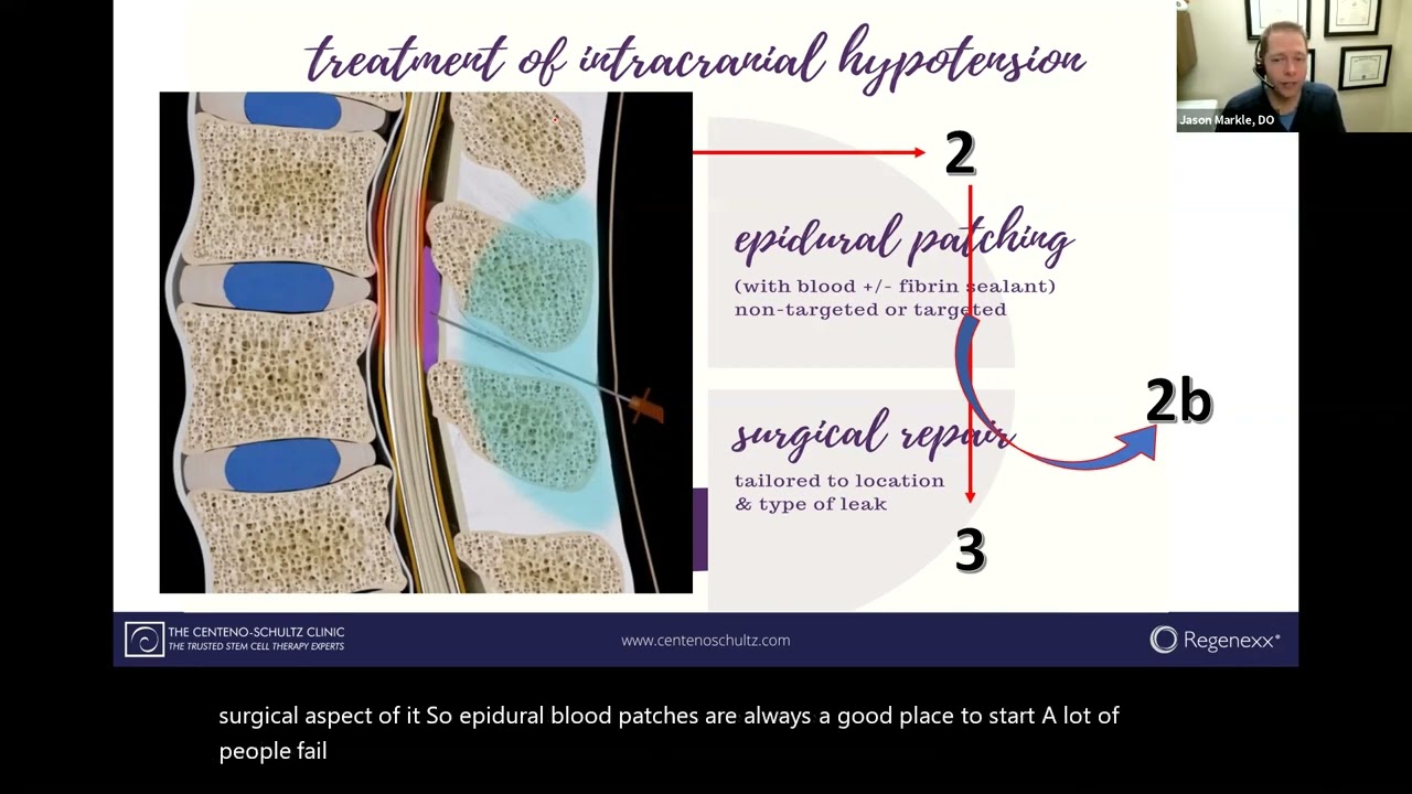Dural Leak   Lumbar Spine
