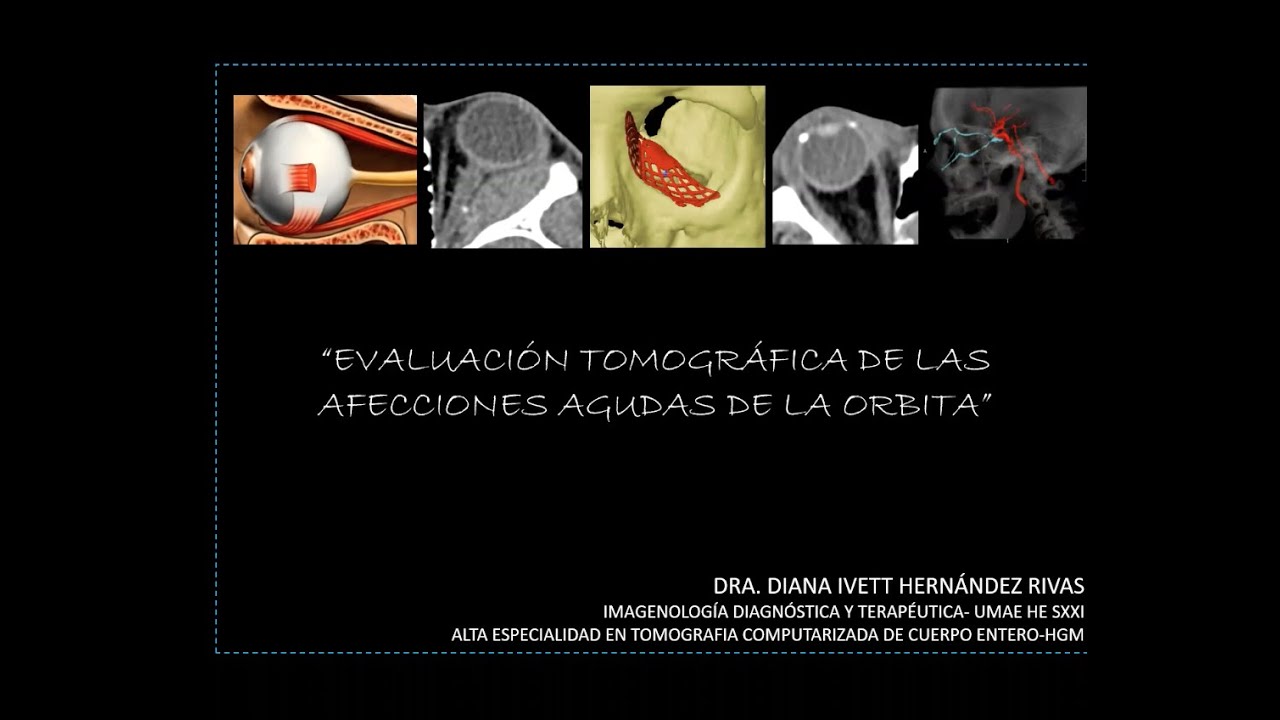 1 - 17 Evaluación tomográfica de las afecciones agudas de la órbita | Dra. Hernández