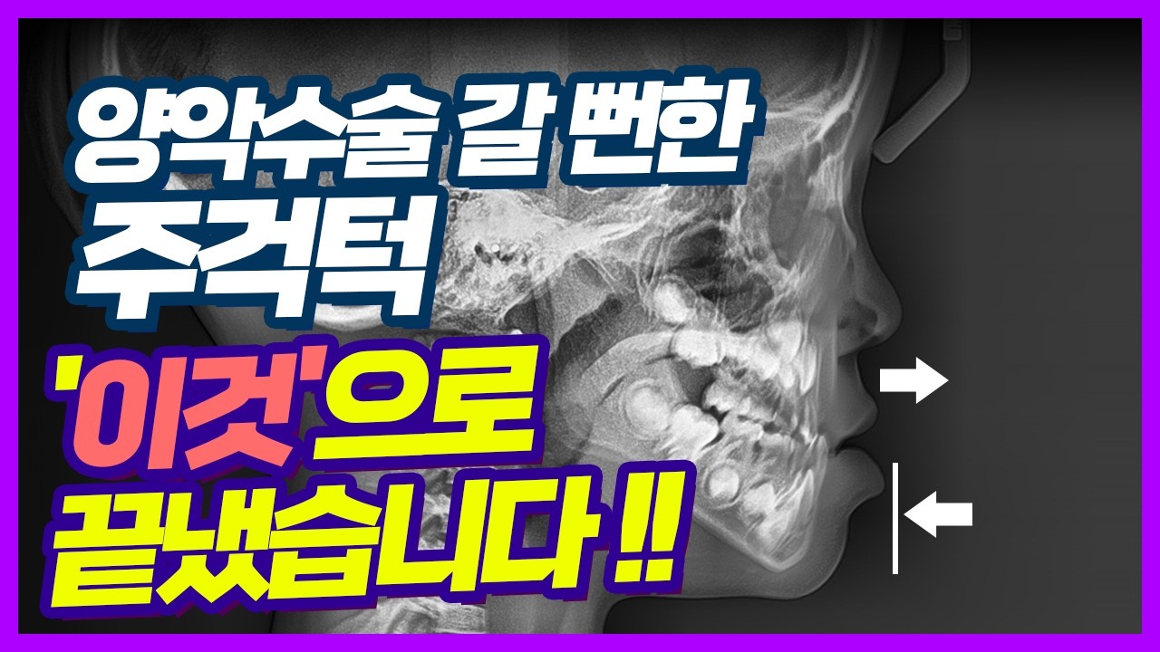 거꾸로 물리는 반대교합, 이렇게 하지 않으면 평생 후회합니다. #주걱턱 #양악수술 #반대교합 #3급부정교합 #시흥교정치과 #교정전후 #이슈 #orthodontics