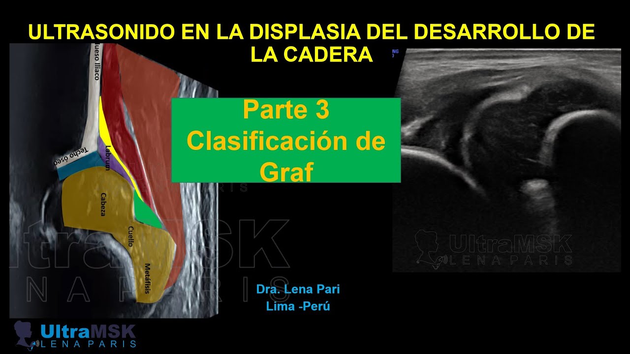 Como utilizar la clasificación de Graf para evaluar la displasia de cadera. Hip dysplasia ultrasound