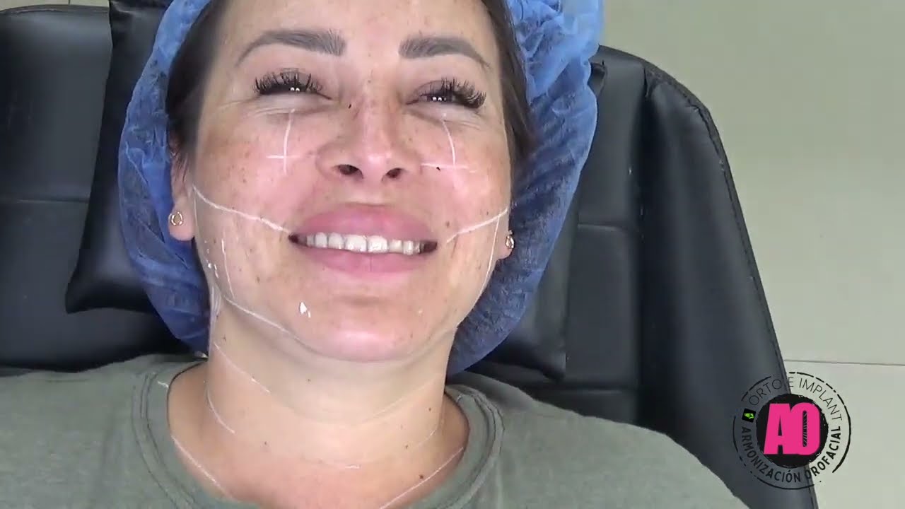 APLICACION DE BOTOX 100 UNIDADES