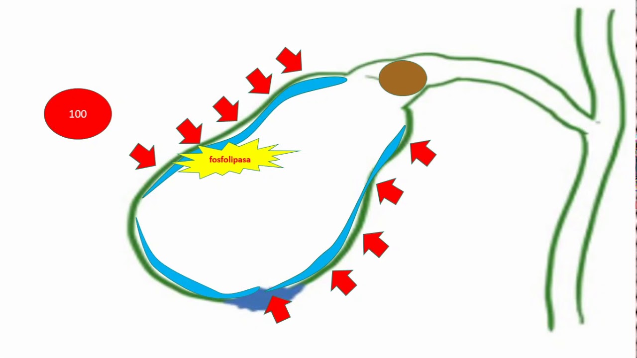 Colecistitis aguda fisiopatologia