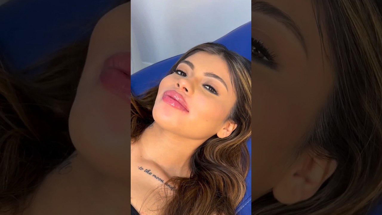 💋 Natural Enhancement with Lip Filler