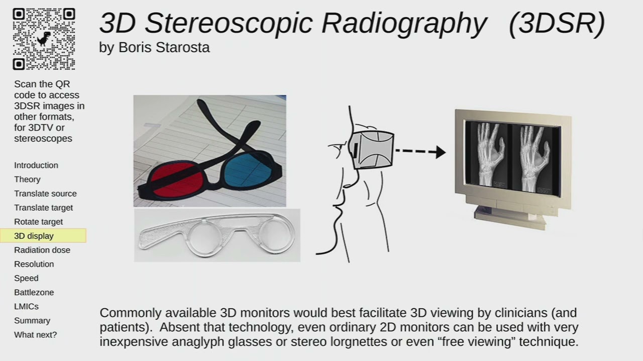 SD&A 2025: Stereoscopic radiography: New possibilities in the digital era using low cost ... (2D)