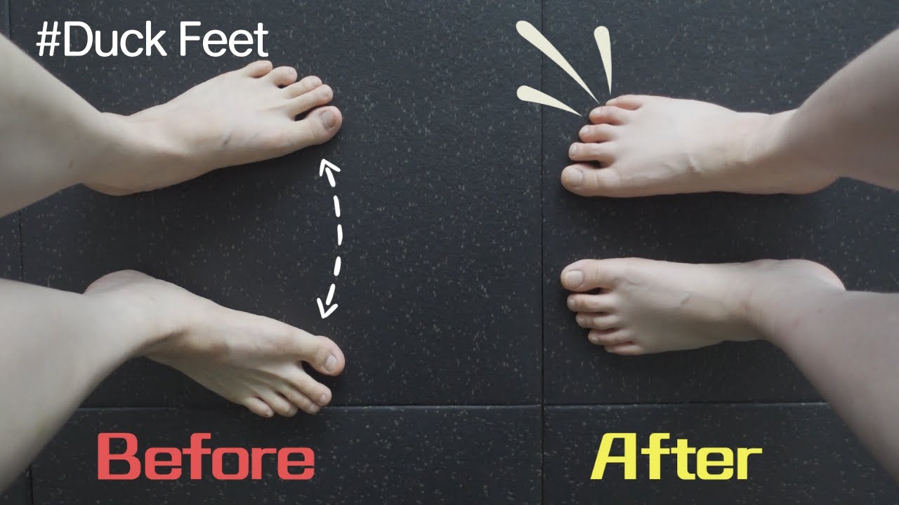 하루 딱 10분으로 팔자걸음 교정 하세요!(Duck Feet? Here's How to Fix It!)