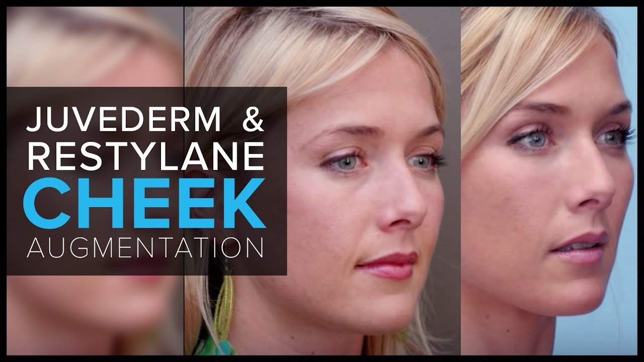 Cheek Augmentation With JUVEDERM® and Restylane® at Mabrie Facial Institute