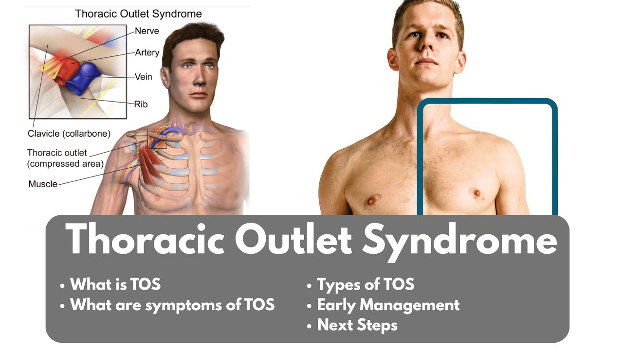 What is Thoracic Outlet Syndrome | Symptoms, Types of TOS, and Early Management