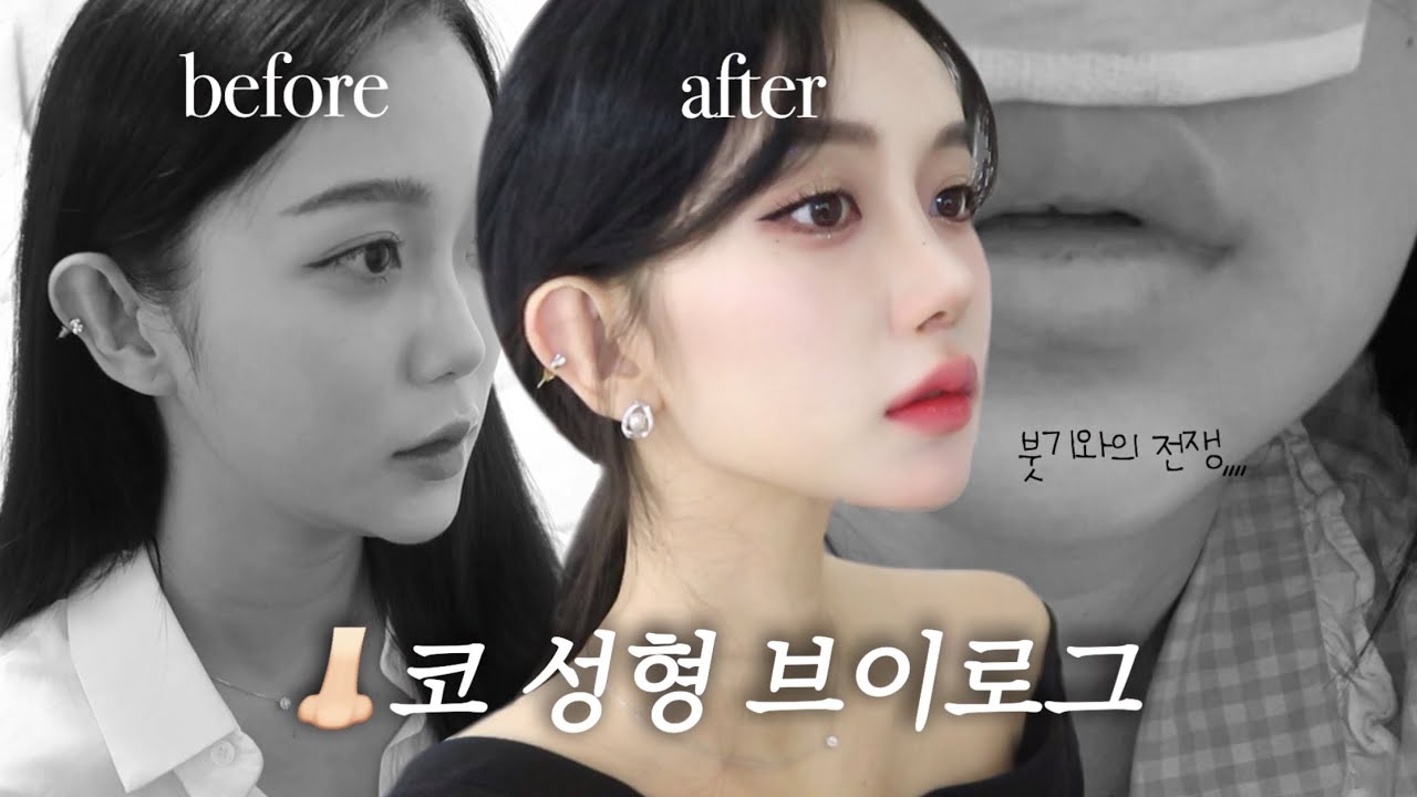 👃🏻코성형 누가 안 아프댔냐,, 지옥같았던 1일차부터 12일차까지 코 수술 브이로그•붓기관리•꿀팁•사후관리•통증 🤯 아름하다