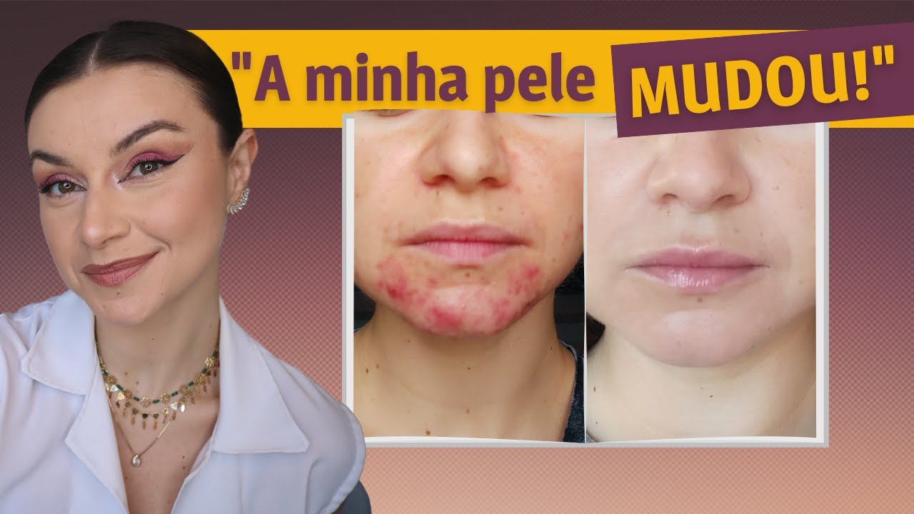 Como usar ácido na pele e o que é o skin Cycling