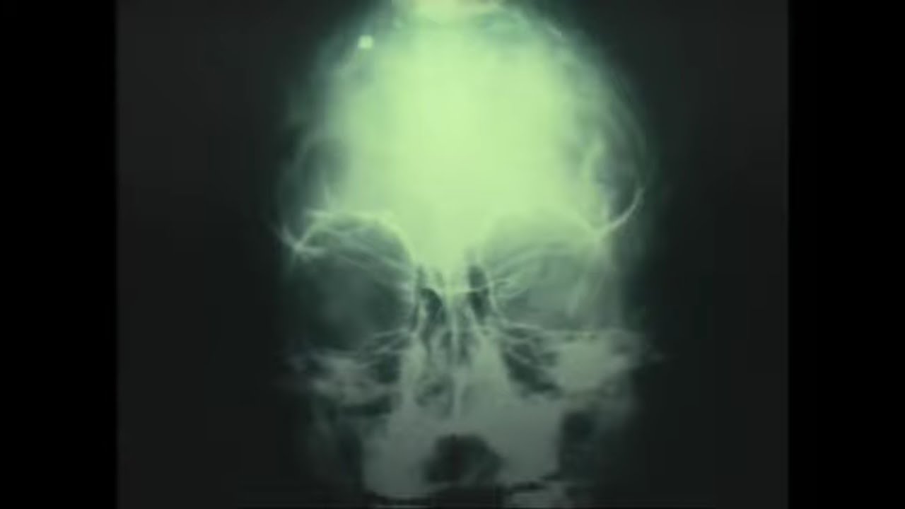 Abductions - Medical Evidence Budd Hopkins