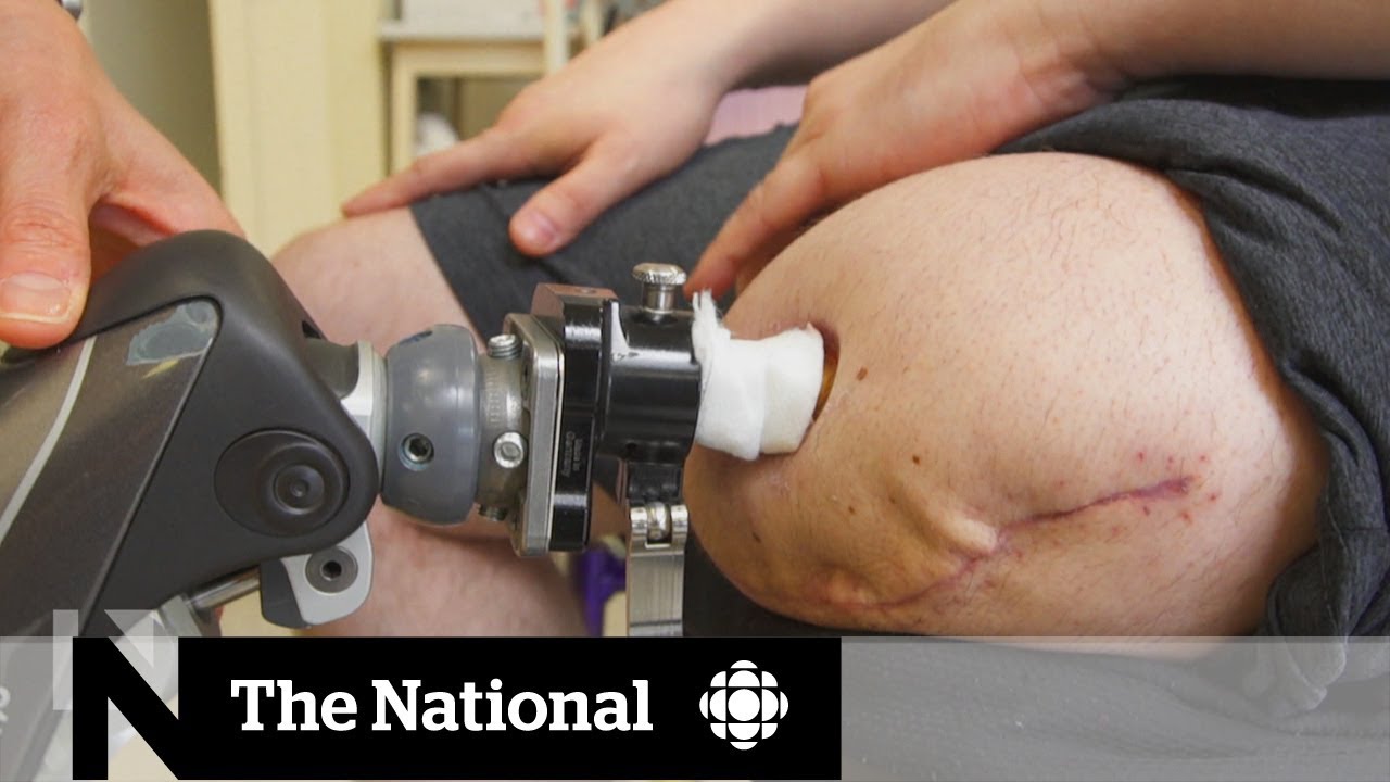 How a new surgical procedure is helping some amputees walk without pain