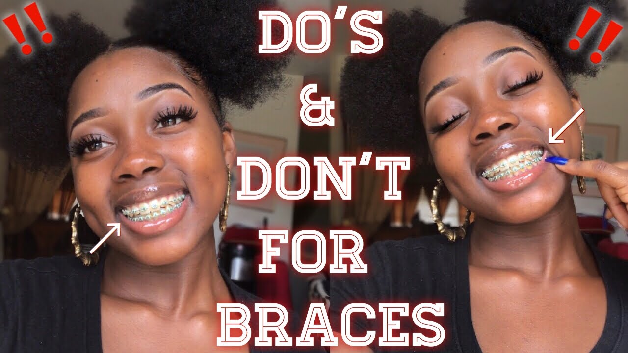 BRACES DO’S & DON’TS‼️ (2019)