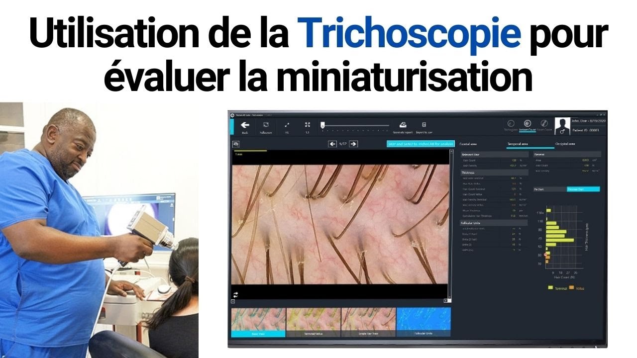 Utilisation de la Trichoscopie pour évaluer la miniaturisation | Aperçu avec Bisanga #26