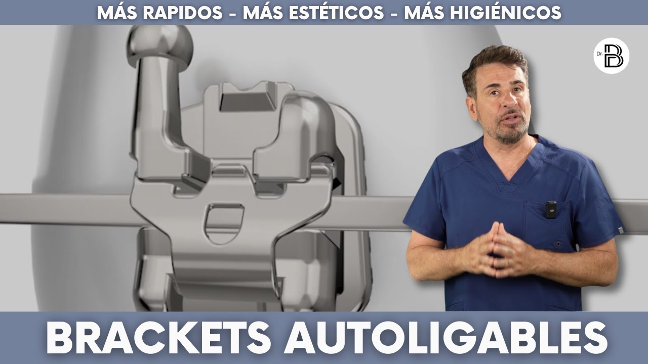 &iquest;Conoces los BRACKETS AUTOLIGABLES y sus ventajas?