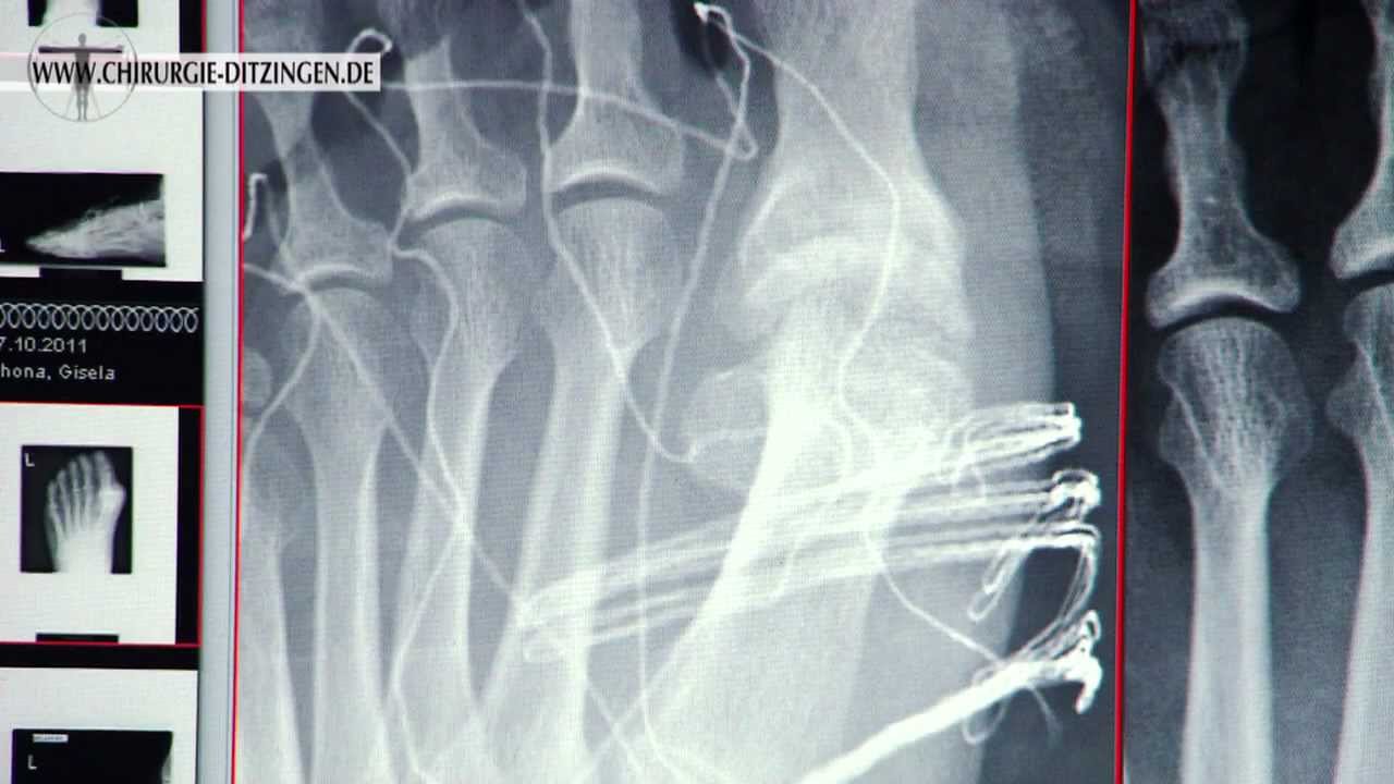 Hallux Rigidus Operation