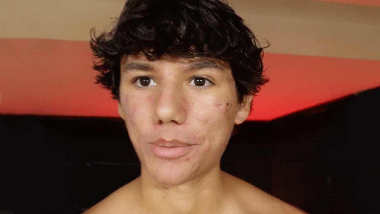 I'm Healing My Acne Faster Than People Taking Accutane (Naturally)