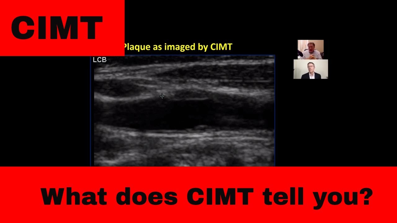 Measuring your Heart Attack RISK - CIMT: Basics (from Todd E's vid)