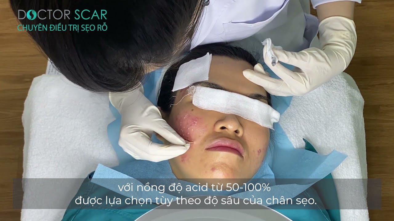 Quy trình chấm TCA trị sẹo rỗ chuẩn y khoa tại Doctor Scar
