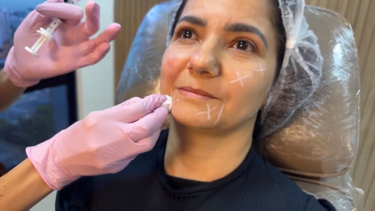 Transmissão Profhilo