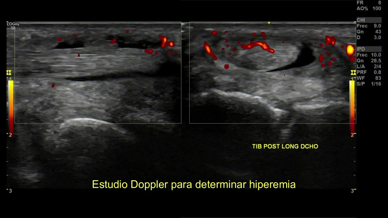 Tenosinovitis del Tibial Posterior